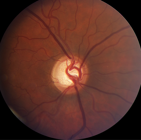 Glaucomatous-Cupping